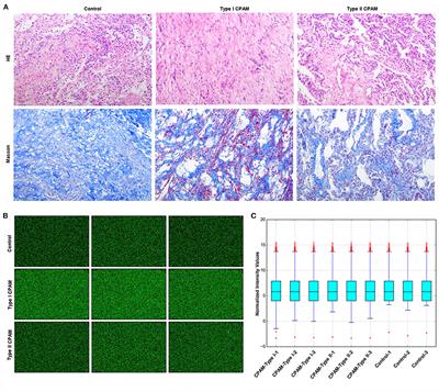 Analysis of miRNA Profiles and the Regulatory Network in Congenital Pulmonary Airway Malformations